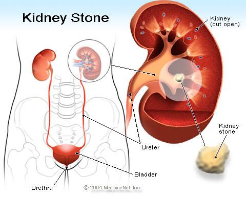 Kidney Stones - Associated Urological Specialists